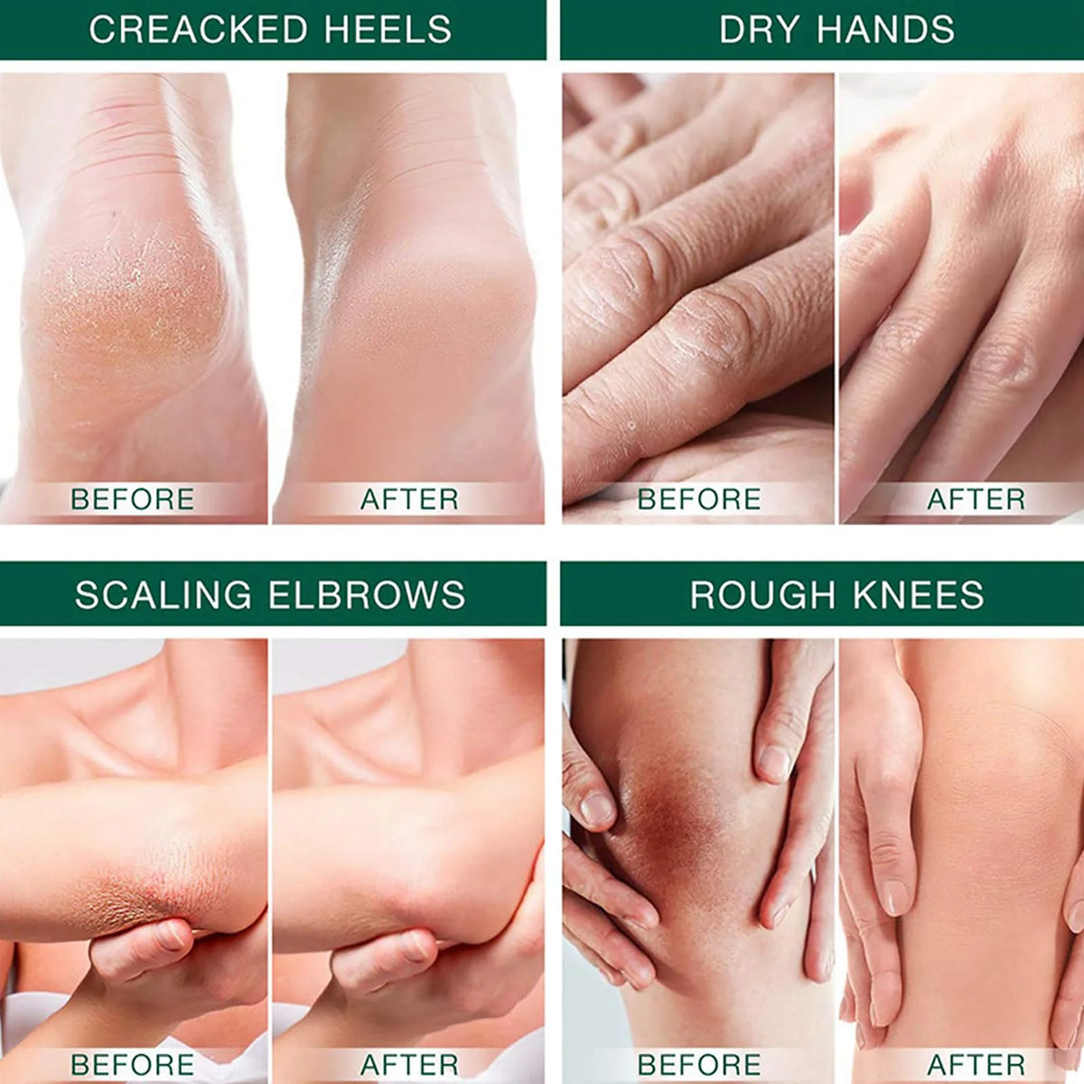 Urea 42% Foot Cream